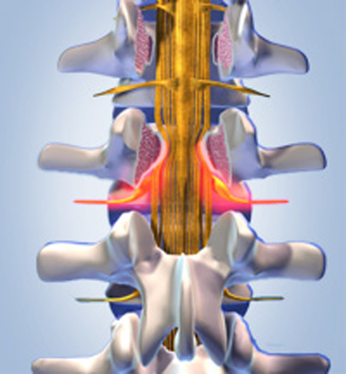 Wirbelkanalverengung - Foramenstenose- Spinalkanalstenose