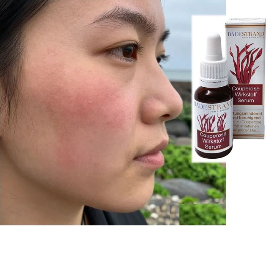 Couperose-Wirkstoff-Serum - Badestrand Kosmetik GmbH (© Badestrand Kosmetik GmbH)