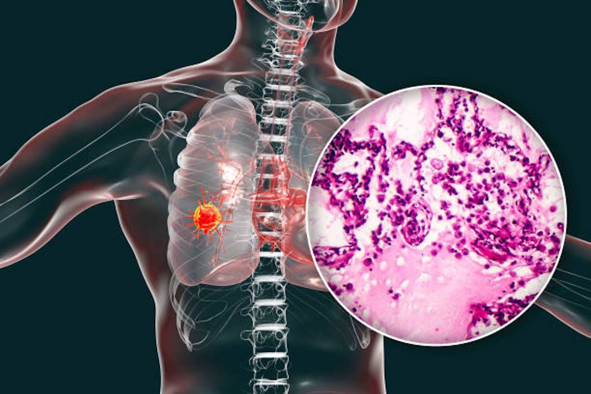 Lungenkarzinom & Immuntherapie dendritische Zelltherapie (© IMMUMEDIC Limited/ Andreas Rach)