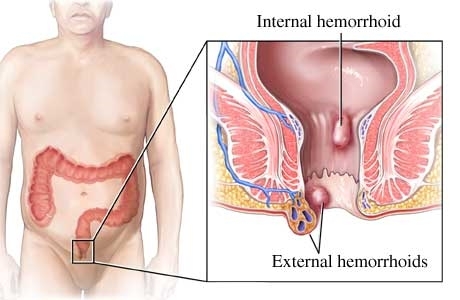 Hämorrhoiden - das letzte Tabu