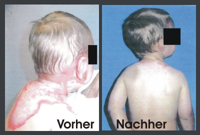 Erfahrungen mit dem einzigartigen Wundheilmittel Theresienöl - dem Wundermittel bei Verbrennungen Erfahrungen mit dem einzigartigen Wundheilmittel Theresienöl - dem Wundermittel bei Verbrennungen