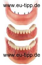 Implantat Implantat