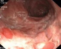 Morbus Crohn im unteren Dünndarm