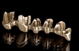 NobelProcera Brücke aus Kobalt-Chrom NobelProcera Brücke aus Kobalt-Chrom