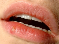 Auszüge der Melisse halten Herpes-Viren in Schach. Auszüge der Melisse halten Herpes-Viren in Schach.