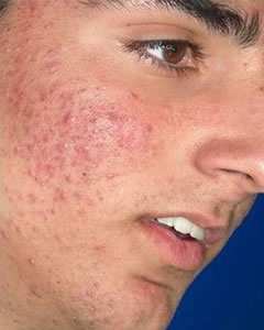 Botox gegen Akne