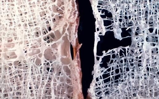 Osteoporose: Therapiepause führt zu gesünderen Knochen