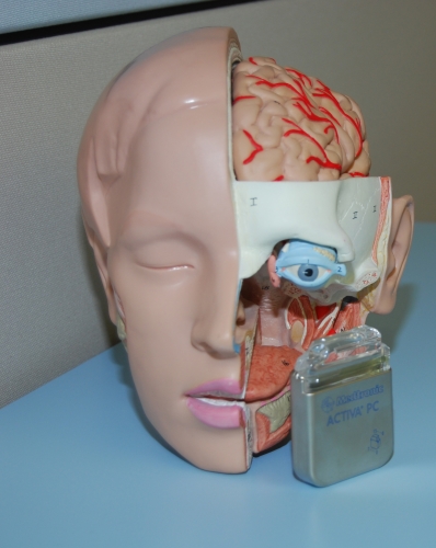 Tiefe Hirnstimulation bei Epilepsie Tiefe Hirnstimulation bei Epilepsie