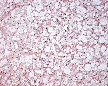Stammzellen aus Eigenfett sollen vermehrt für die Transplantationsmedizin eingesetzt werden Stammzellen aus Eigenfett sollen vermehrt für die Transplantationsmedizin eingesetzt werden
