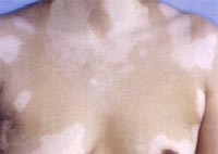 Doch heilbar ! Vitiligo Doch heilbar ! Vitiligo