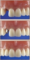 Implantate Implantate