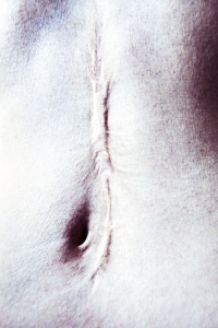KEETMAN, PURA VIDA, Hodgkin’s disease