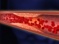 Arteriosklerose
