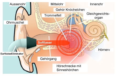Tinnitus die erfolgreiche Selbstbehandlung und Softlasertherapie mit EarNoiseEliminator bei Tinnitus