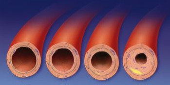 Mikronährstoffe sind wichtige Biomoleküle im Schutz gegen Atherosklerose Bild: lom123, fotolia.de Mikronährstoffe sind wichtige Biomoleküle im Schutz gegen Atherosklerose Bild: lom123, fotolia.de