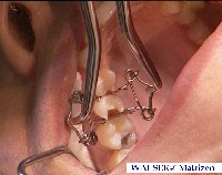Walser Matrize/Foto: Dr. Walser Dental GmbH Walser Matrize/Foto: Dr. Walser Dental GmbH