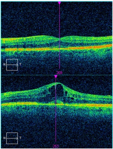 Oben: Optische Kohärenztomographie (OCT) eines gesunden Auges: Die Netzhaut ist gleichmäßig dick, nu Oben: Optische Kohärenztomographie (OCT) eines gesunden Auges: Die Netzhaut ist gleichmäßig dick, nu