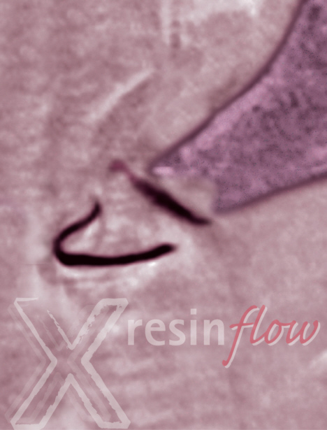 X-resin flow Röntgenopaker Silikonlack. Prothetisch orientiert, einfach und schnell