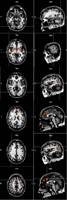 fMRI image (Marshall et al, NNR 2007) fMRI image (Marshall et al, NNR 2007)