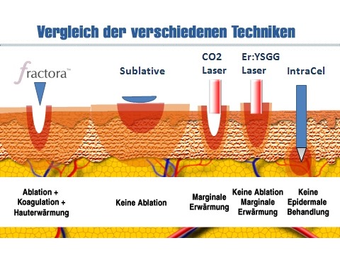 Fractora?: Synthese verschiedenster Methoden für eine glättere und straffere Haut Fractora?: Synthese verschiedenster Methoden für eine glättere und straffere Haut