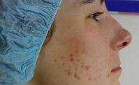 Akne-Behandlungen mit IPL-Geräten von PreSwede Akne-Behandlungen mit IPL-Geräten von PreSwede
