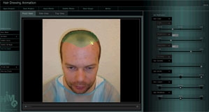 Programm?Hair Drawing Animation? ermöglicht virtuelle Haartransplantation Programm?Hair Drawing Animation? ermöglicht virtuelle Haartransplantation