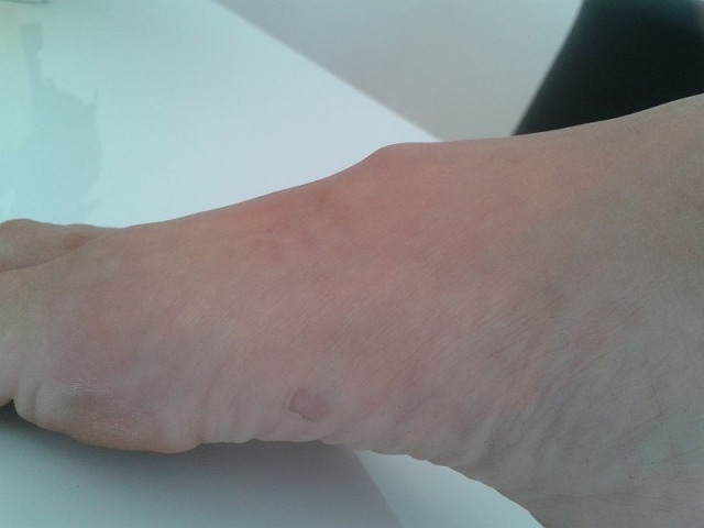 Überbein (Ganglion) am Fußrücken