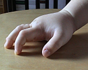HAE - Schwellung der Hand HAE - Schwellung der Hand