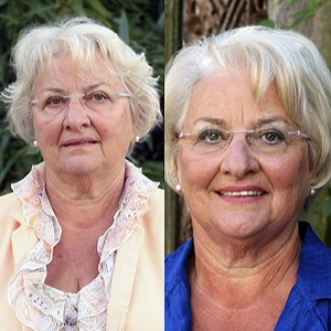 Vorher-Nachher