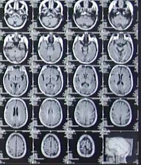 Mit der Magnetresonanztomographie (MRT) untersuchen Kliniker das Gehirn schmerzfrei. (Foto: J. Wolff Mit der Magnetresonanztomographie (MRT) untersuchen Kliniker das Gehirn schmerzfrei. (Foto: J. Wolff