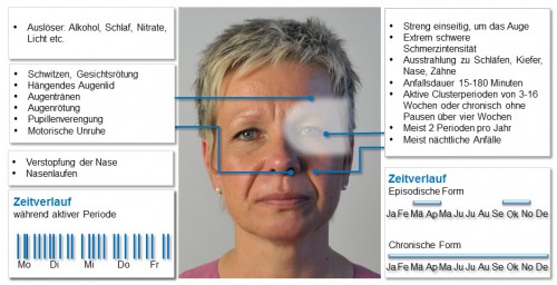 Symptome und Verlaufsmerkmale von Clusterkopfschmerzen