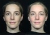 Vor dem Laserpeel und 10 Tage danach Vor dem Laserpeel und 10 Tage danach