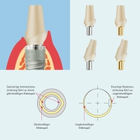 Übersicht Zirkonabutment von bredent medical
