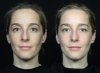 Ergebnis 1 Monat nach der Laserpeel-Behandlung Ergebnis 1 Monat nach der Laserpeel-Behandlung
