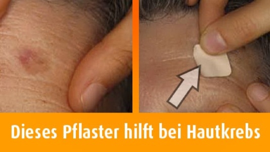 Ein Pflaster zur Bekämpfung von hellem Hautkrebs.