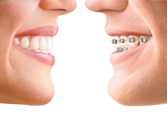 links: invisalign Schiene; rechts: konventionelle feste zahnspange links: invisalign Schiene; rechts: konventionelle feste zahnspange
