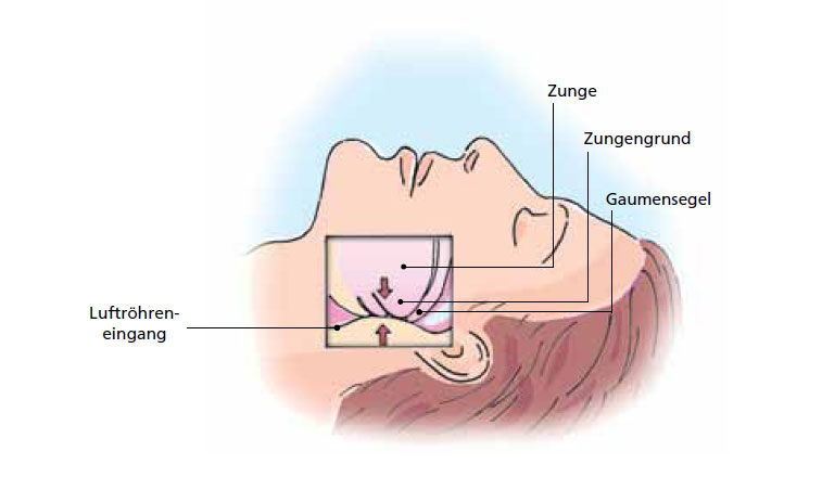 CPAP CPAP