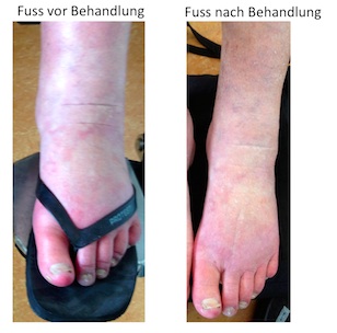 Fuesse vor und nach Behandlung Fuesse vor und nach Behandlung