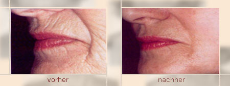 Ein Ergebnis nach 8 Behandlungen Bio-Lifting Ein Ergebnis nach 8 Behandlungen Bio-Lifting