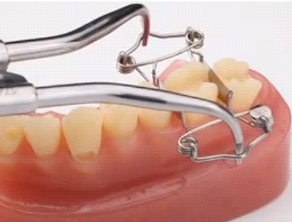 Zahn Matrize/Foto: Dr. Walser Dental GmbH Zahn Matrize/Foto: Dr. Walser Dental GmbH