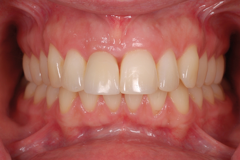 SKY elegance abutments von bredent medical; Foto: Dr. Manolakis, Saloniki SKY elegance abutments von bredent medical; Foto: Dr. Manolakis, Saloniki