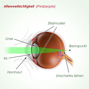 Altersweitsichtigkeit