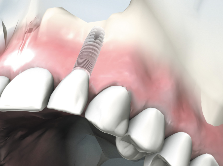 narrowSKY von bredent medical narrowSKY von bredent medical