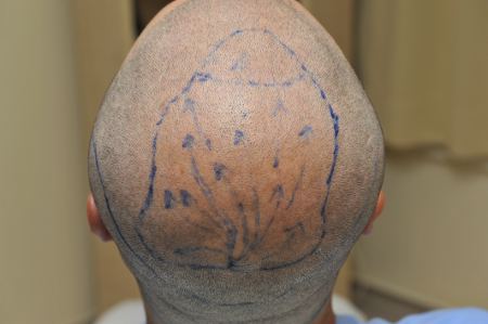Haartransplantation Haartransplantation