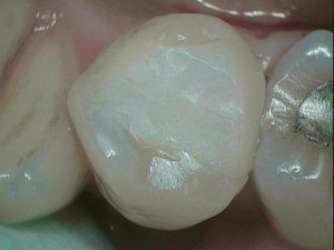 Finden Sie die vollkeramische Einlagefüllung, welche nach dem Cerec-System vor 8 Jahren im Backenzah Finden Sie die vollkeramische Einlagefüllung, welche nach dem Cerec-System vor 8 Jahren im Backenzah